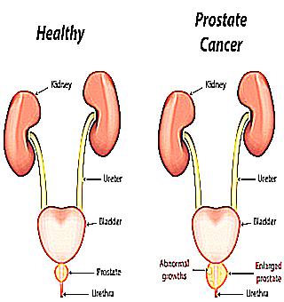 Adenomectomy For Prostate Cancer