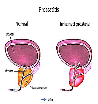 All Symptoms And Signs Of Acute And Chronic Prostatitis In Men