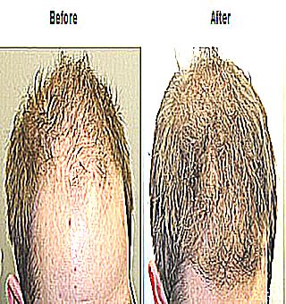 Baldness Remedy Propecia