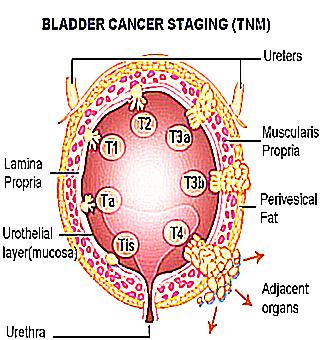 Bladder Cancer Symptoms And Treatment