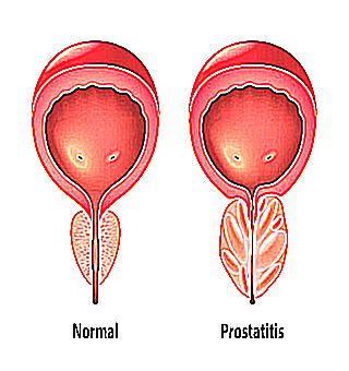 Can Candidiasis Cause Prostatitis