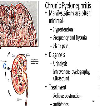 Chronic Pyelonephritis And Prostate Adenoma