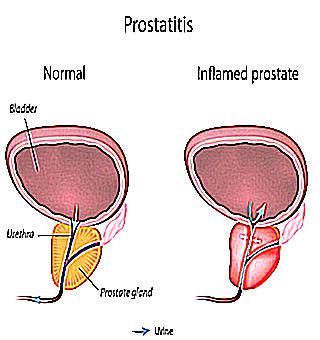 Coitus Interruptus With Prostatitis