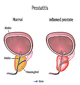 Consequences Of Male Prostatitis For The Female Body