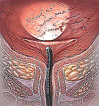 Cystitis Can Go Into The Urethra
