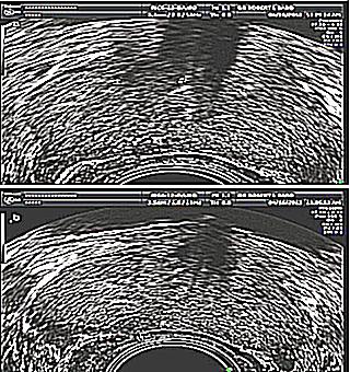 Description Of The Prostate Ultrasound Procedure