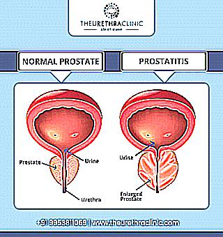 Diagnosis Of Prostatitis In The Clinic And At Home
