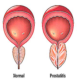 Discharge From Prostatitis With Blood
