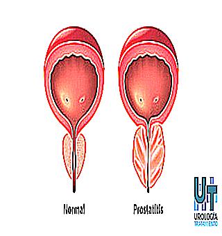 Effect Of Prostatitis On Semen