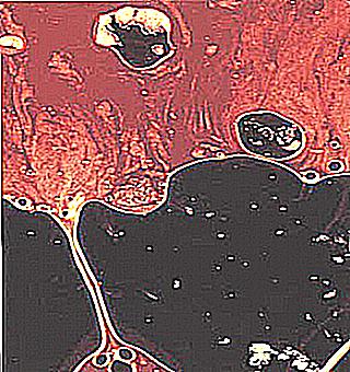 Eruption Of Semen With Blood