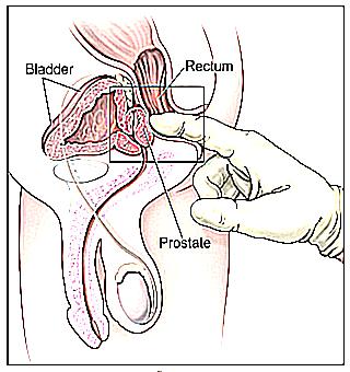 Examination Of The Prostate Gland Of The Bladder