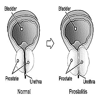 How To Get Rid Of Chronic Prostatitis