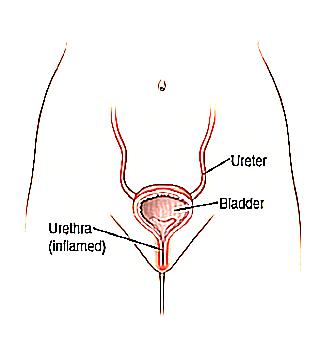 Inflammation Of The Urethra In Men