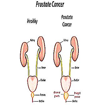 Kidney Stone In Prostate Cancer