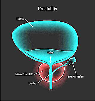 Long Sexual Intercourse With Prostatitis