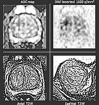 Make An MRI With Prostate Contrast