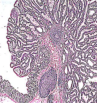 Male Gland Adenoma