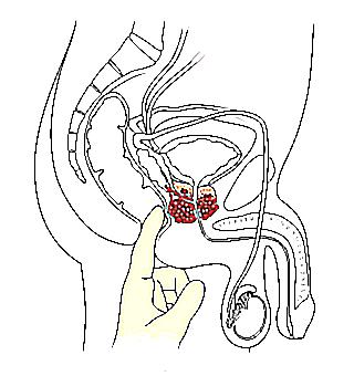 Male Rectal Finger Examination