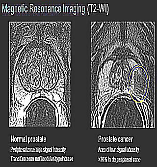 MRI Of The Pelvis In Prostate Diseases