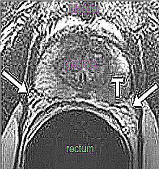 MRI Or Trusion Of The Prostate