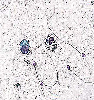 Necrospermia What Is This Disease And How Can A Man Treat It