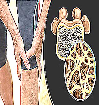 Osteoporosis Symptoms And Treatment
