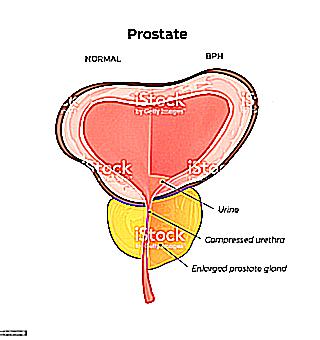 Prostate Adenoma 1 Degree