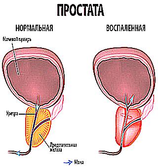 Prostate Adenoma Blood May Appear In The Urine
