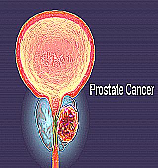 Prostate Cancer Is Prostate Cancer