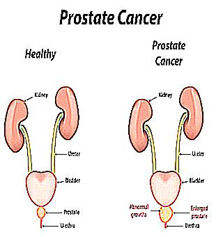 Prostate Inflammation Symptoms And Treatment