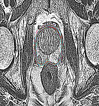 Prostate MRI What It Is For
