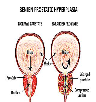 Prostate Symptoms And Treatments