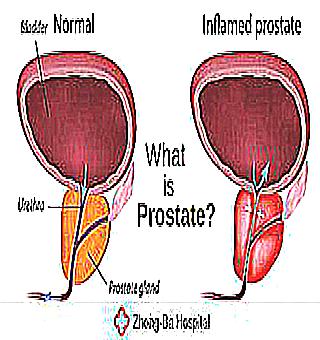 Prostatic Hyperplasia As A Benign Mass