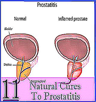 Prostatitis Types Of Symptoms Treatment