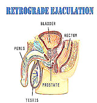 Retrograde Ejaculation In Men Why It Occurs And How To Treat It