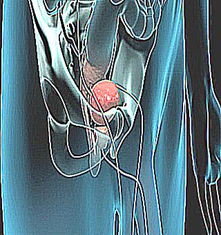 Sensations In The Anus With Prostatitis