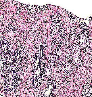 Suspicion Of Prostate Adenocarcinoma