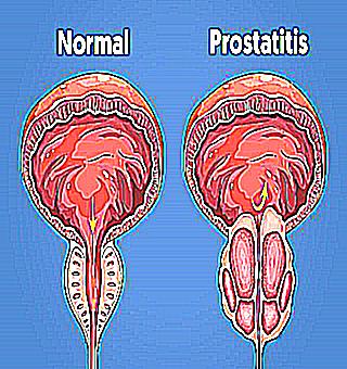 Symptoms And Treatment Of Infectious Prostatitis In Men Causes