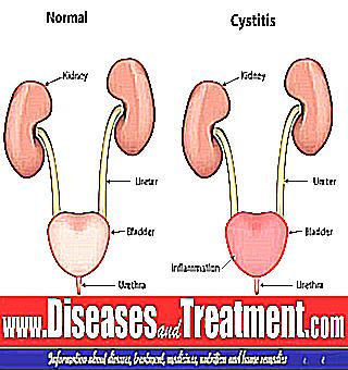 Symptoms Of Male Cystitis