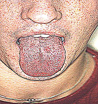 Syphilis On The Tongue