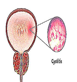Tablets For Male Cystitis Indications And Characteristics