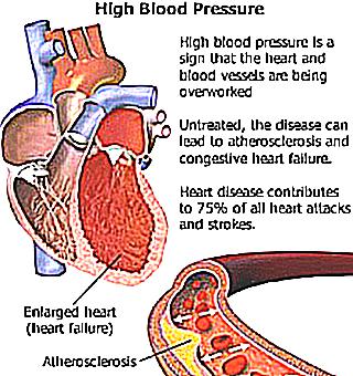 The Effect Of Hypertension On Potency