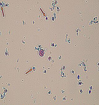 The Occurrence Of Increased Leukocytes In Urine