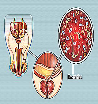 The Role Of Nutrition In The Treatment Of Prostatitis