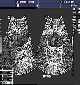 Transabdominal Ultrasound Of The Prostate