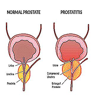 Treat Chronic Prostatitis At Home
