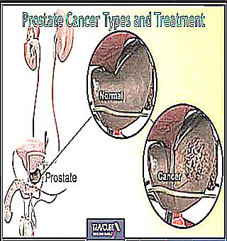 Treatment And Prevention Of Prostatitis