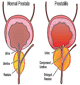 Treatment Of Acute Inflammation Of The Prostate
