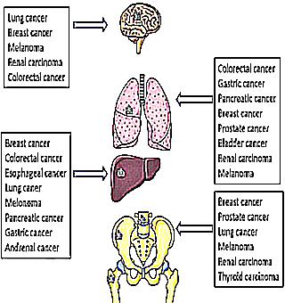 Tumor Metastases Symptoms And Treatment