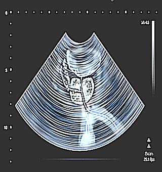 Ultrasound Of The Prostate